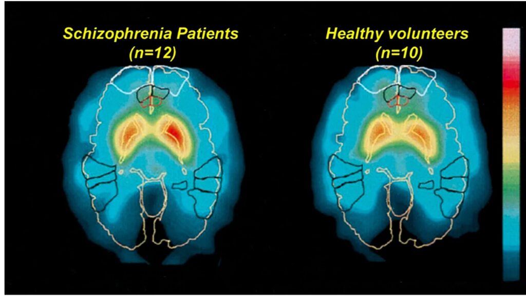 تشخیص دقیق اسکیزوفرنی با هوش مصنوعی BrainProbe در تایوان